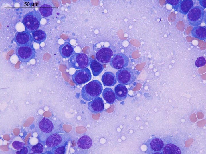 Lymph node imprint: group of atypical plasmacytes and plasmablasts