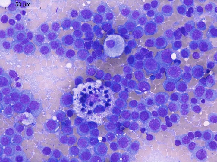 Lymph node imprint: macrophage with phagocytosed cellular debris