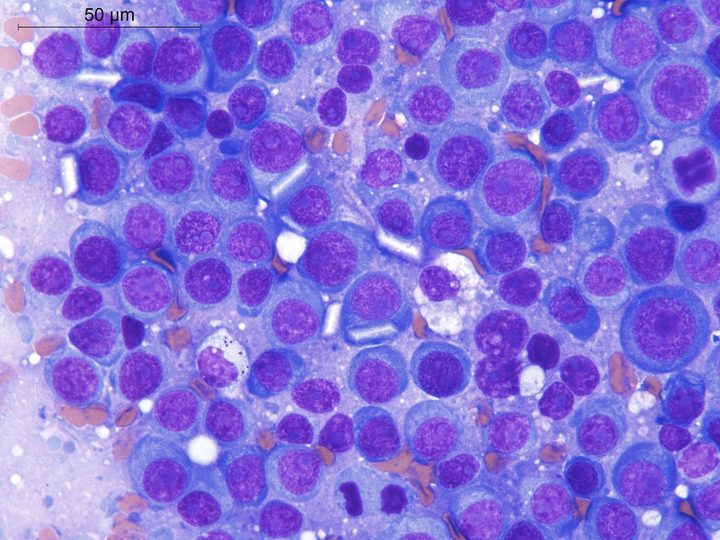 Cytology of imprint: atypical plasmablasts with crystalline structures
