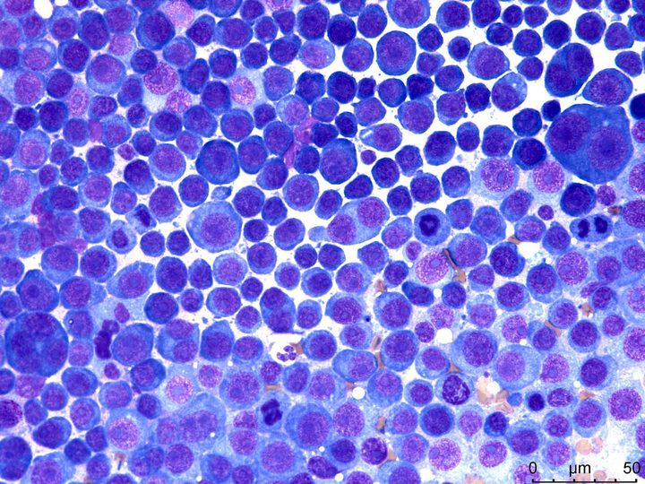 Lymph node imprint: high cellularity, pronounced atypia of plasmacytes