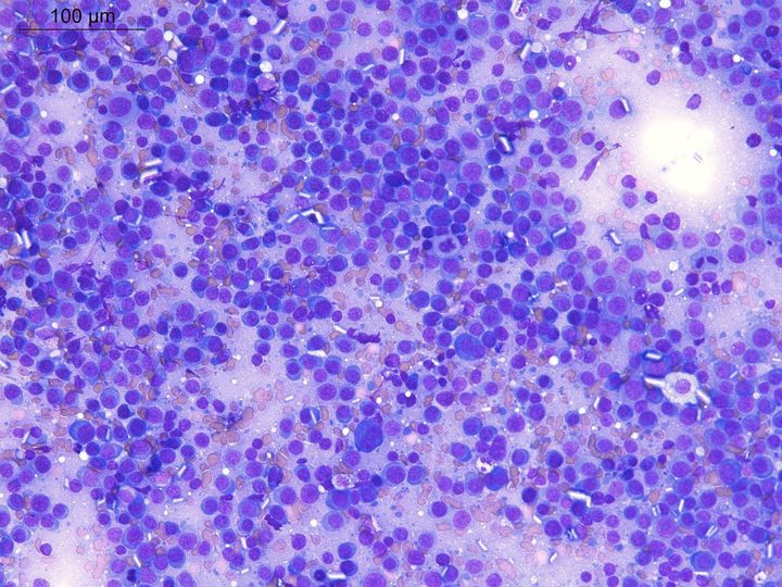 Overview image of lymph node imprint: diffuse infiltration by plasmablasts