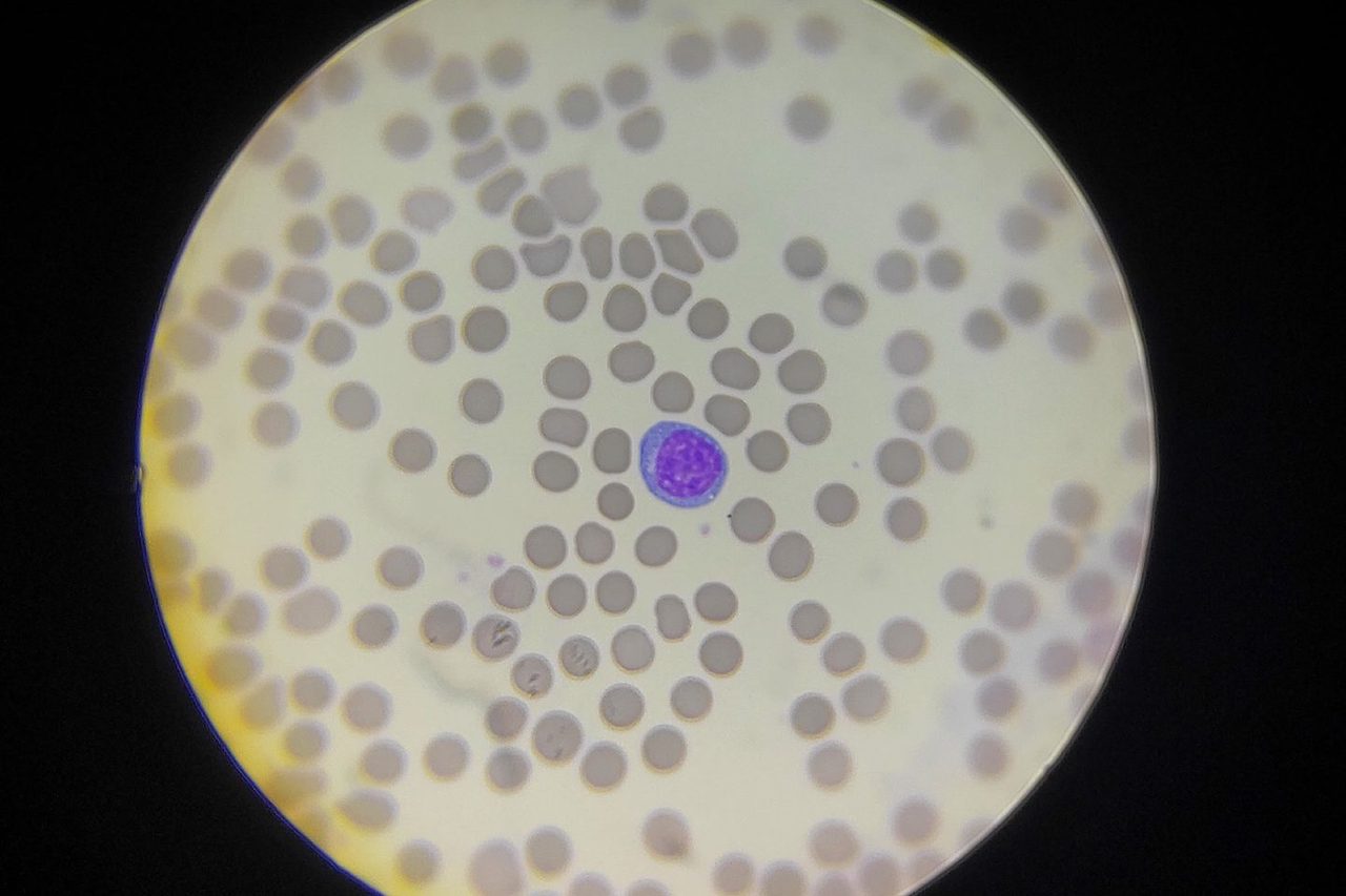 Plasmacytoid Lymphocytes: Morphology and Scattergram