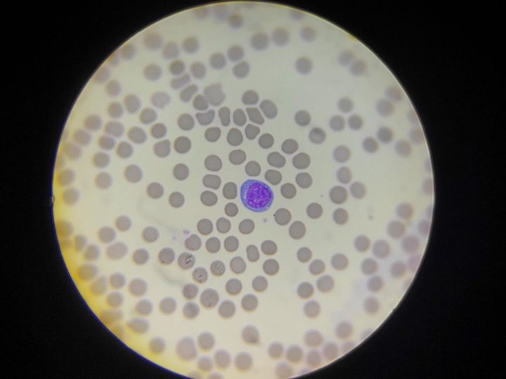 Blood smear: plasmacytoid lymphocyte with basophilic cytoplasm
