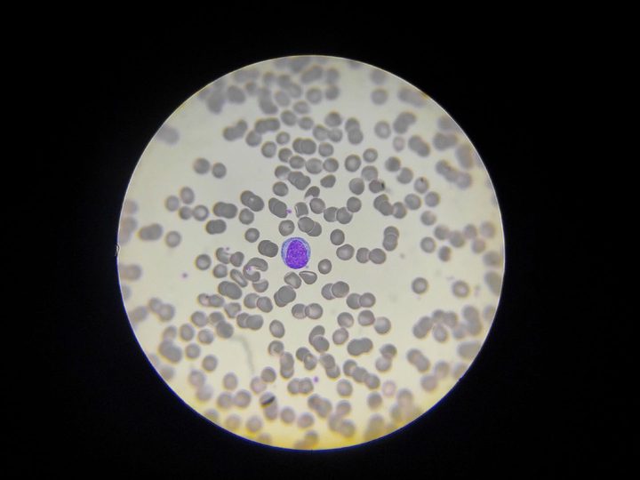 Blood smear: reactive lymphocyte with compact nucleus and blue cytoplasm