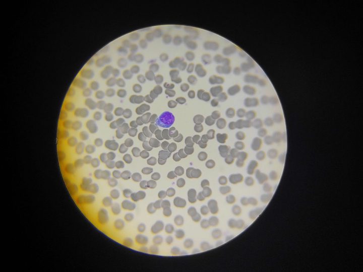 Blood smear: plasmacytoid lymphocyte with eccentric nucleus