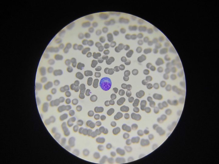 Blood smear: reactive lymphocyte with perinuclear clearing of the cytoplasm