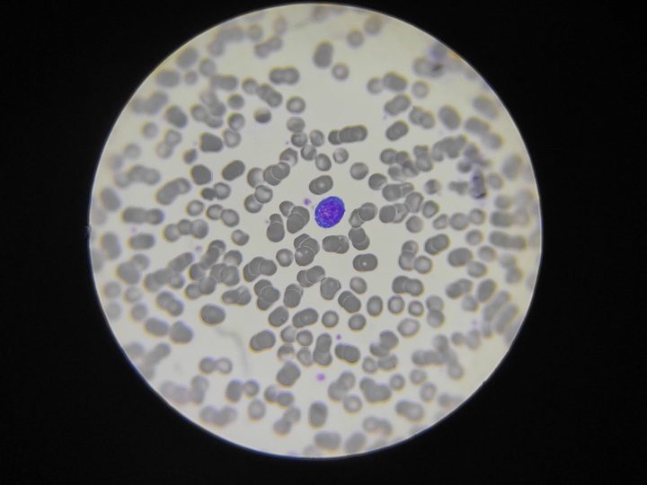Blood smear: typical plasmacytoid lymphocyte with coarse chromatin structure