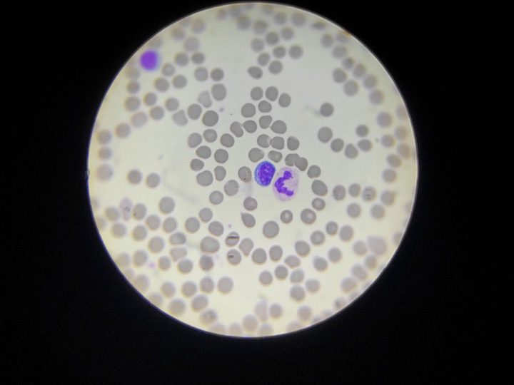 Blood smear: plasmacytoid lymphocyte and segmented neutrophil