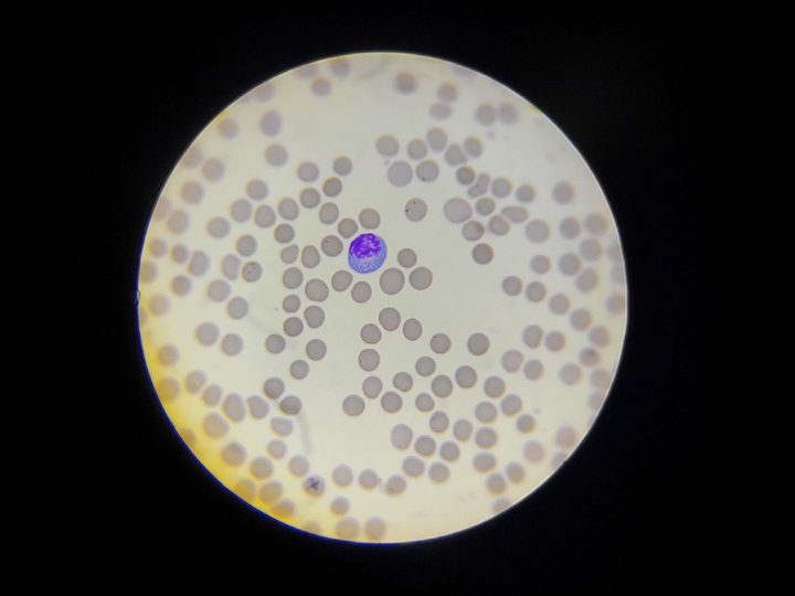 Blood smear: lymphocyte with pronounced basophilia of plasmacytoid-type cytoplasm