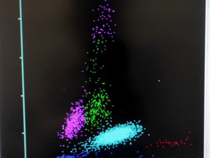 Analyzer printout: leukocyte scattergram with an elongated upward lymphocyte cloud