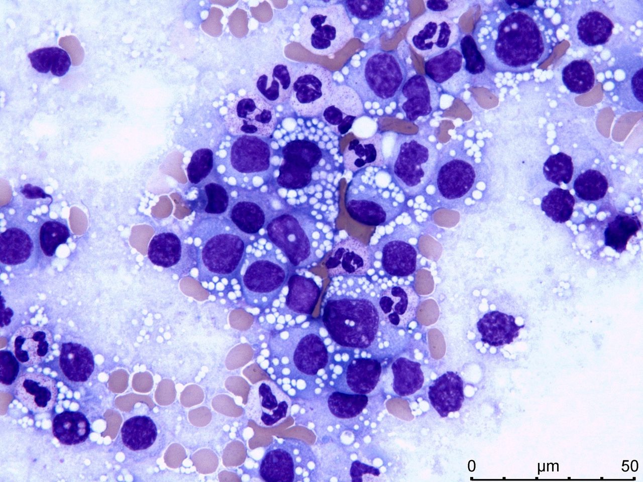 Lymph Node Plasmacytoma in Multiple Myeloma: Cytology