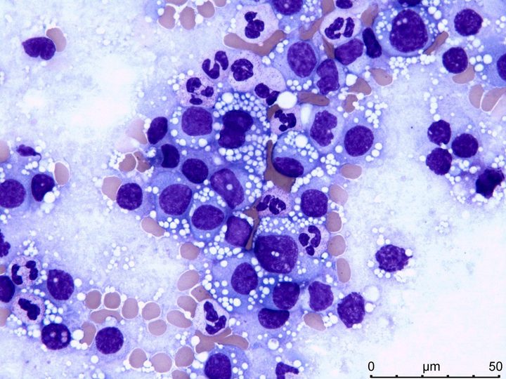 Lymph node imprint: tumor plasma cells with cytoplasmic vacuolization and neutrophils