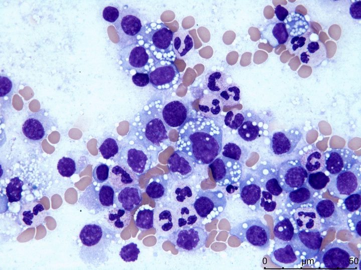 Lymph node imprint smear: polymorphic plasma cells surrounded by neutrophils