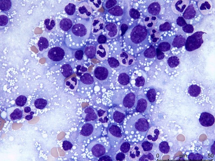 Lymph node imprint: tissue infiltration by plasma cells and neutrophilic leukocytes