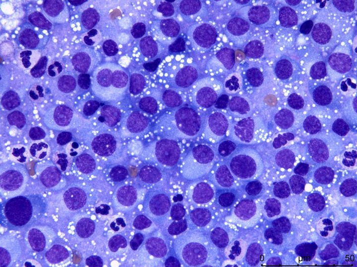 Lymph node cytological preparation: binucleated plasma cell against a background of neutrophils