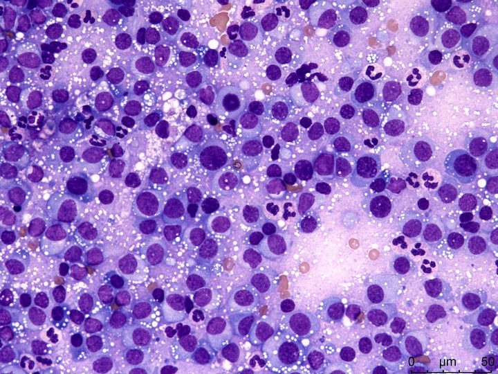 Lymph node imprint smear in plasmacytoma: massive accumulation of plasma cells
