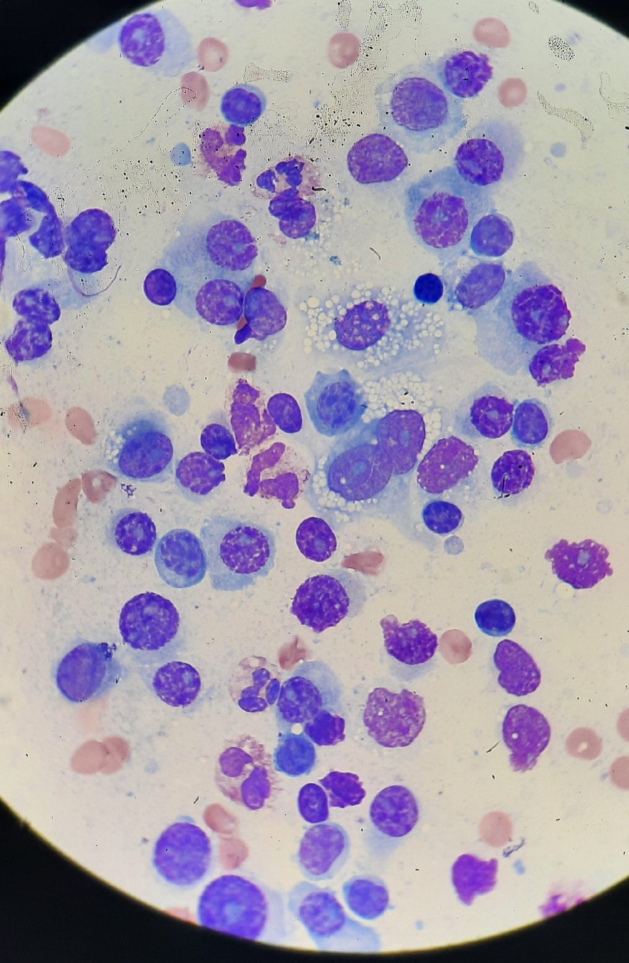 Imprint smear of an oropharyngeal lesion: infiltration by atypical plasmacytes