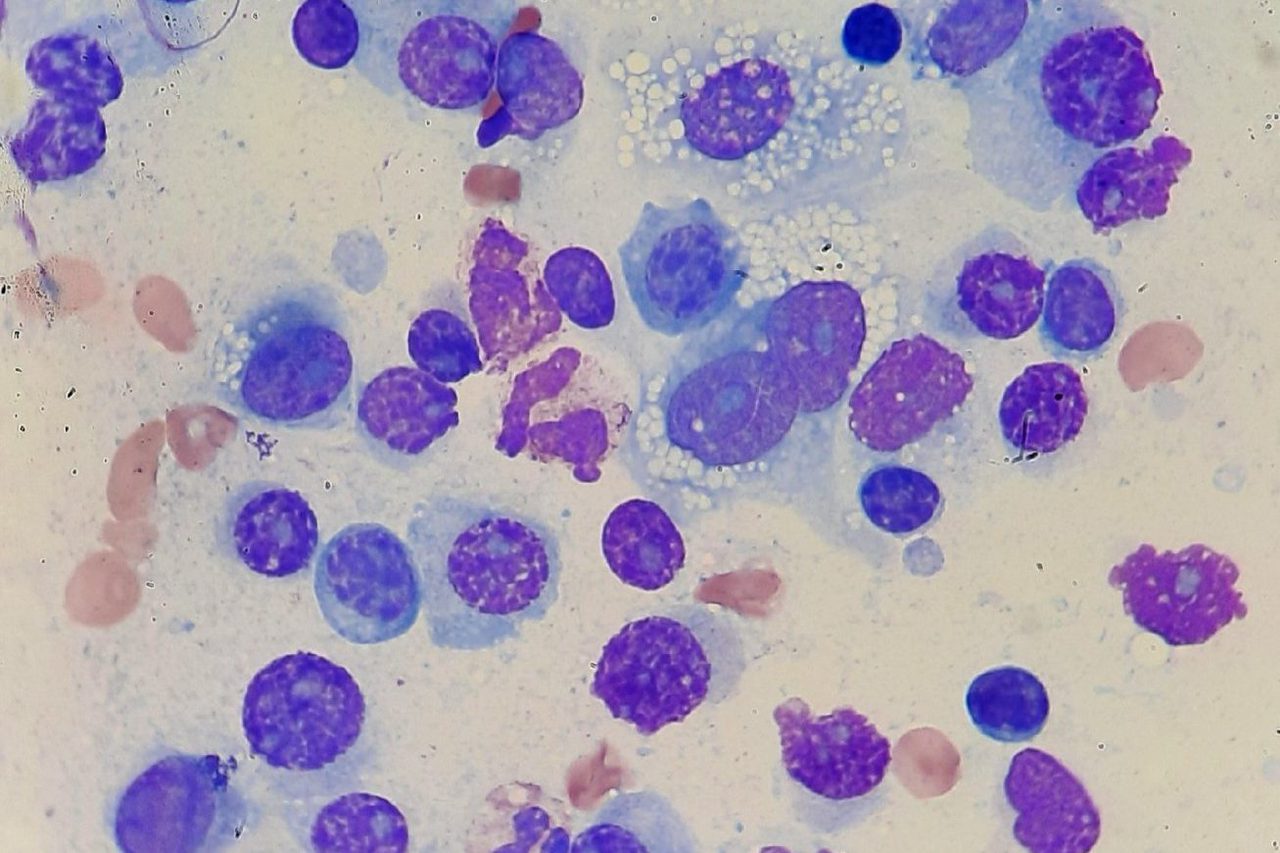 Oropharyngeal Plasmacytoma: Cytological Diagnosis