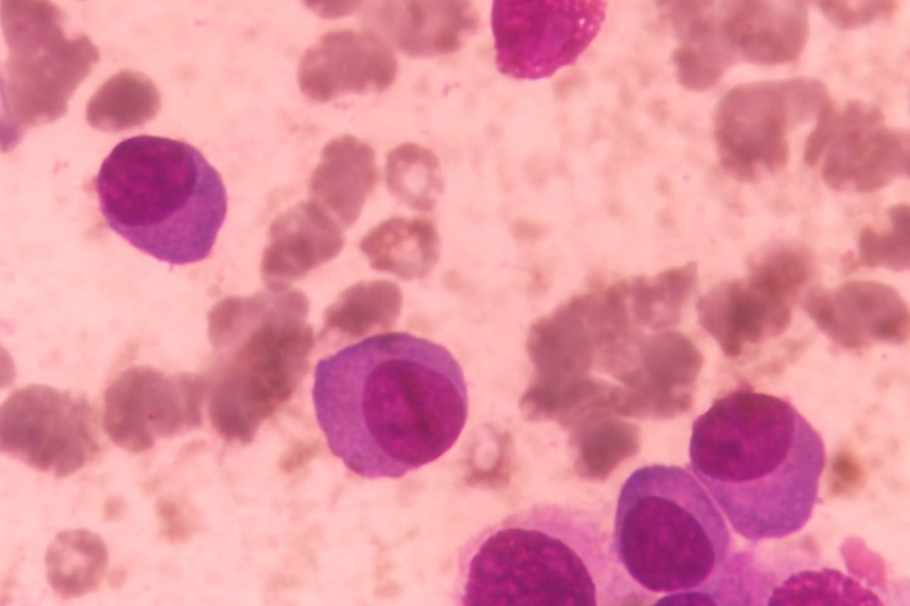 Bone Marrow Plasmacytosis in Multiple Myeloma