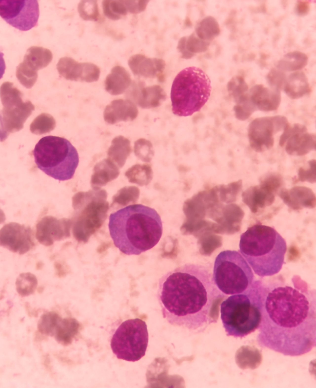 Bone Marrow Plasmacytosis in Multiple Myeloma