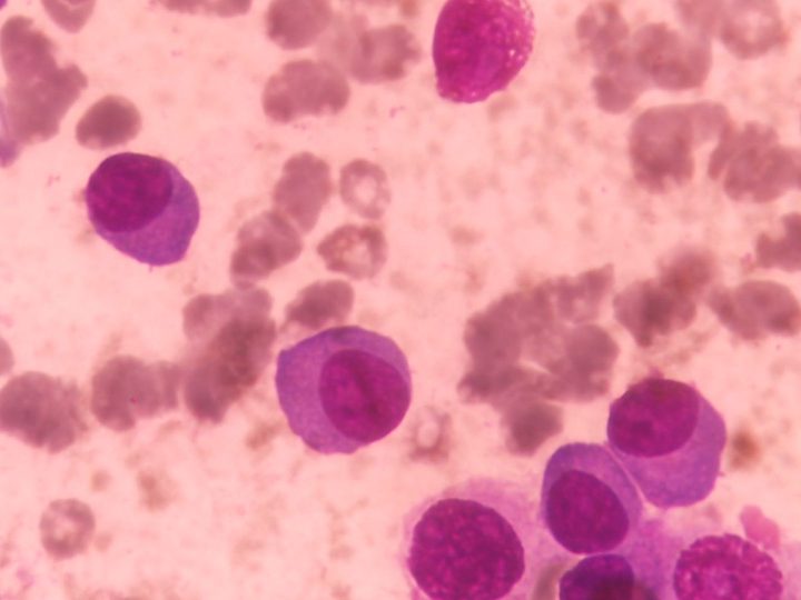 Bone marrow smear: plasma cells with eccentric nucleus and basophilic cytoplasm