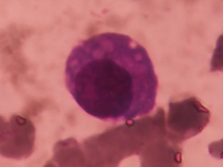 Bone marrow smear: atypical plasmacyte with cytoplasmic vacuolization