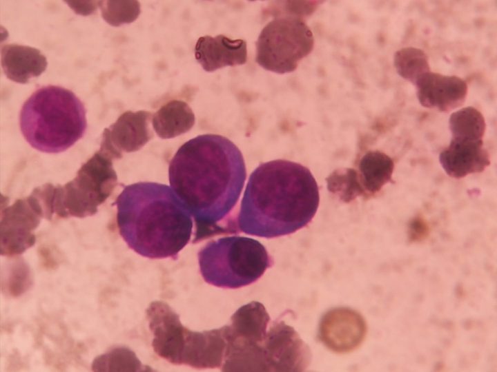 Bone marrow smear: compact cluster of plasma cells