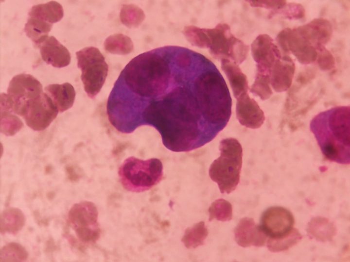 Bone marrow smear: large binucleated atypical plasmacyte