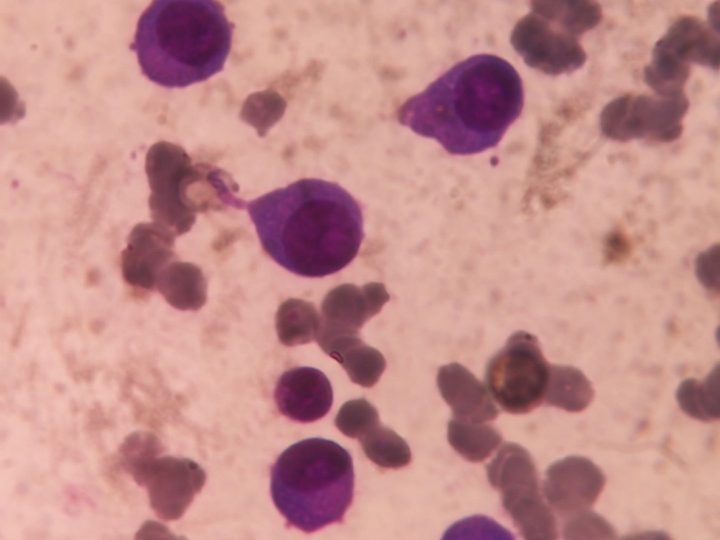 Bone marrow smear: field of view with plasma cells