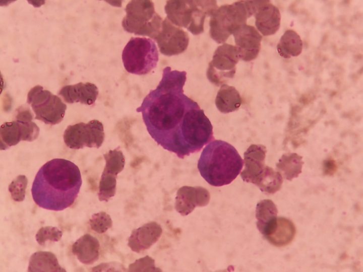 Bone marrow smear: binucleated plasma cell in myeloma