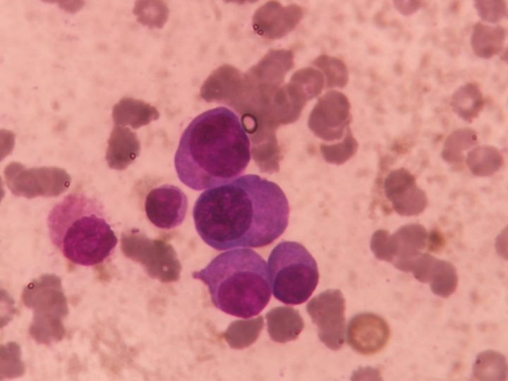 Bone marrow smear: group of plasma cells of varying maturity