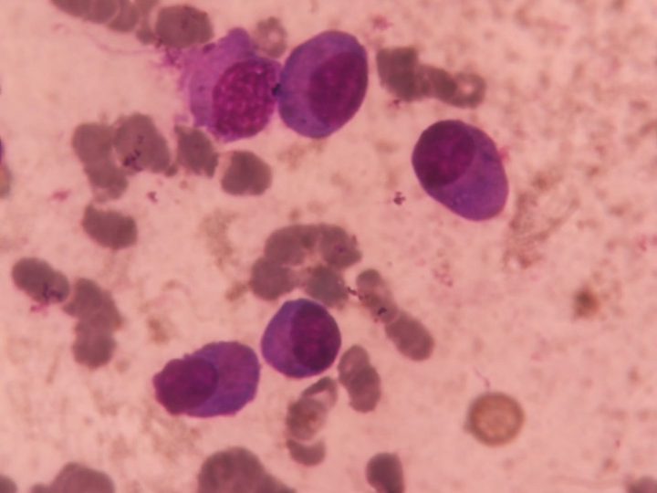 Bone marrow smear: plasma cells with perinuclear clearing