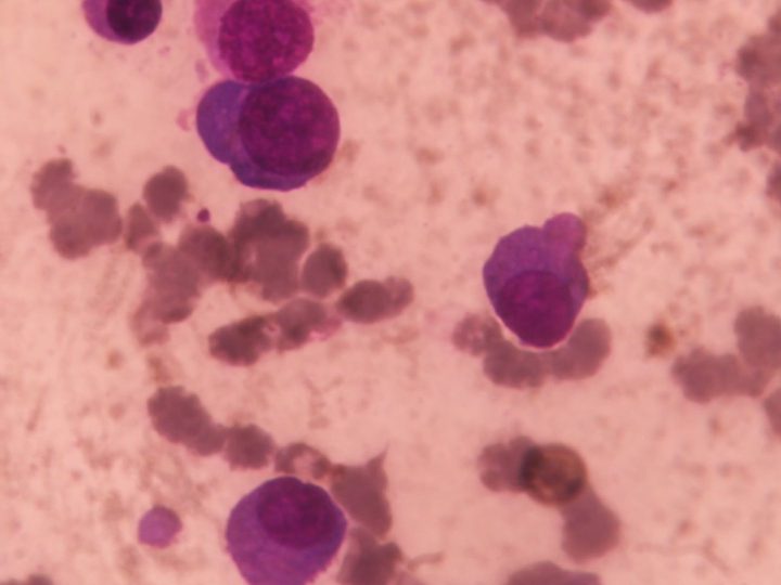 Bone marrow smear: polymorphism of plasma cells in myeloma