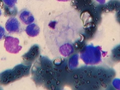 Мазок костного мозга, вакуолизированный плазмоцит среди клеточных элементов
