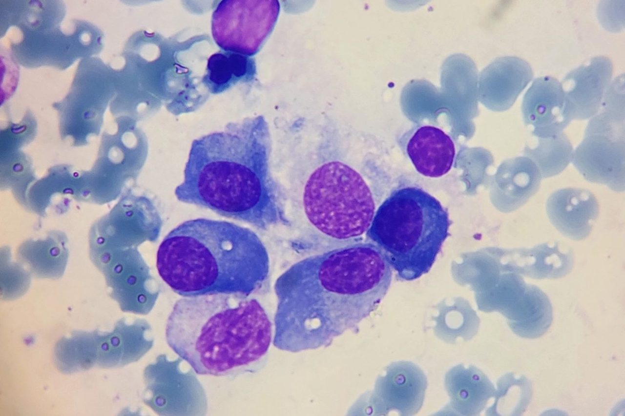 Bone Marrow Plasmacytosis: Causes and Differential Diagnosis