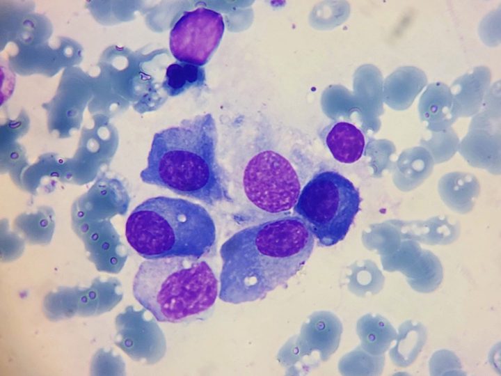Bone marrow smear: accumulation of plasma cells with eccentric nuclei