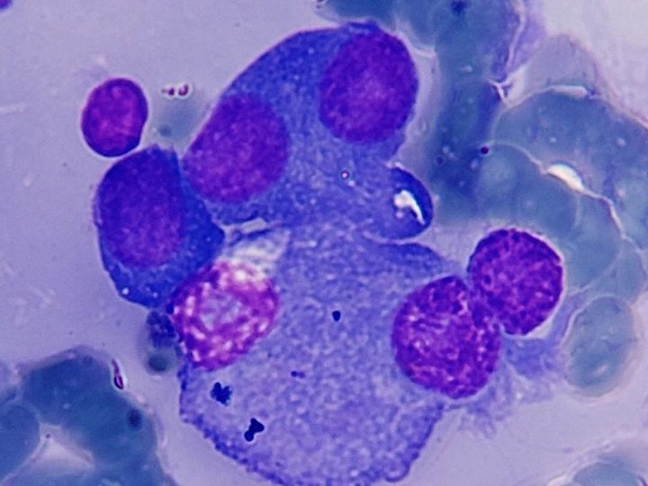 Bone marrow smear: group of plasma cells with pronounced cytoplasmic basophilia