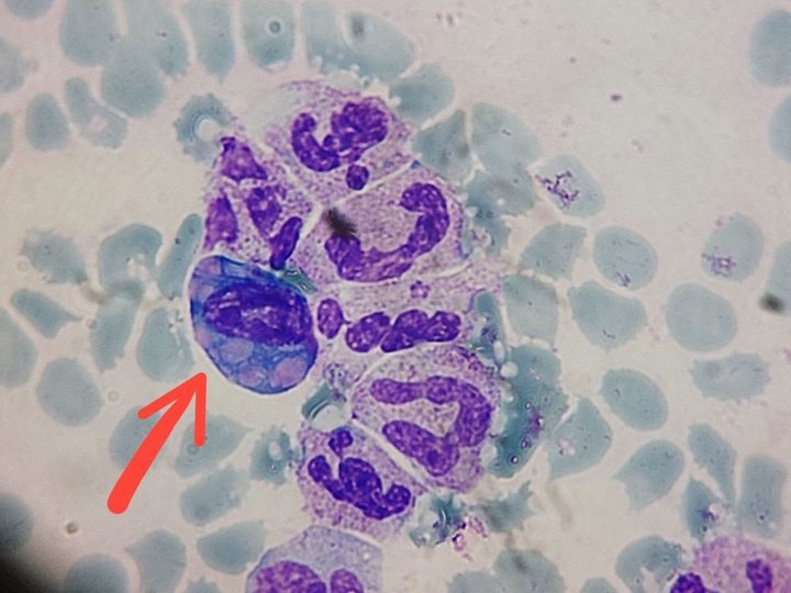 Bone marrow smear: Mott cell with Russell bodies (arrow)