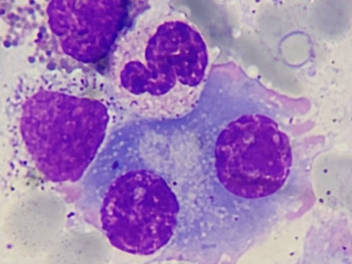 Bone marrow smear: plasma cells and granulocytic series cells