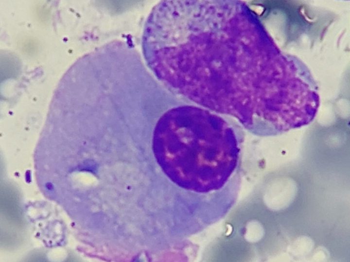 Bone marrow smear: plasma cell with a typical perinuclear halo
