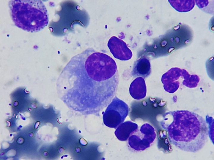 Bone marrow smear: plasma cell among maturing leukocytes
