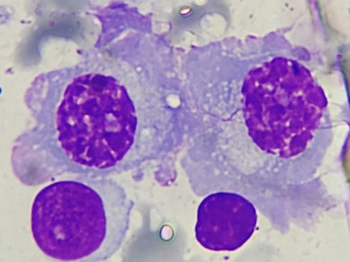 Bone marrow smear: contacting plasma cells with a cartwheel chromatin pattern