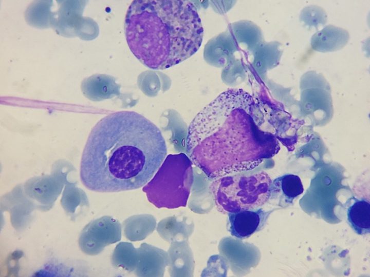 Bone marrow smear: plasma cell and granulocytic hematopoietic elements