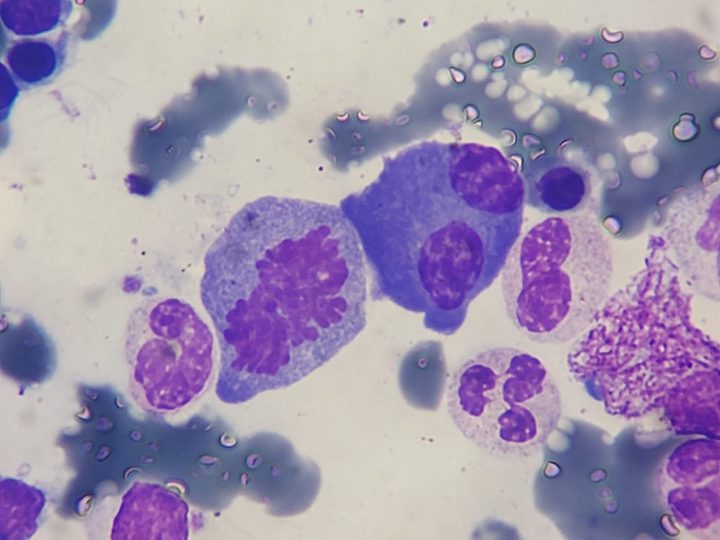Bone marrow smear: mitotic figure of a bone marrow cell next to a plasma cell