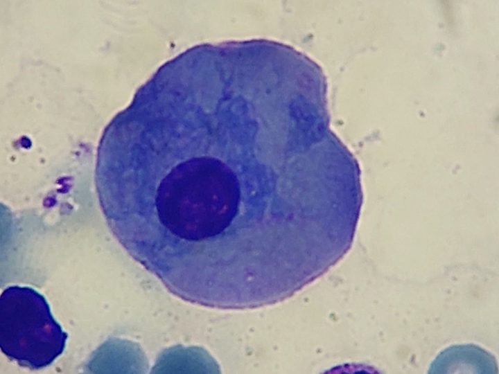 Bone marrow smear: large mature plasma cell with an eccentrically located nucleus