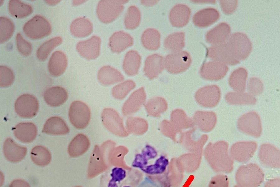 Plasma Cells in Blood Smear in Multiple Myeloma