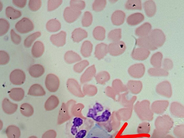Blood smear: two plasma cells with basophilic cytoplasm and eccentric nuclei