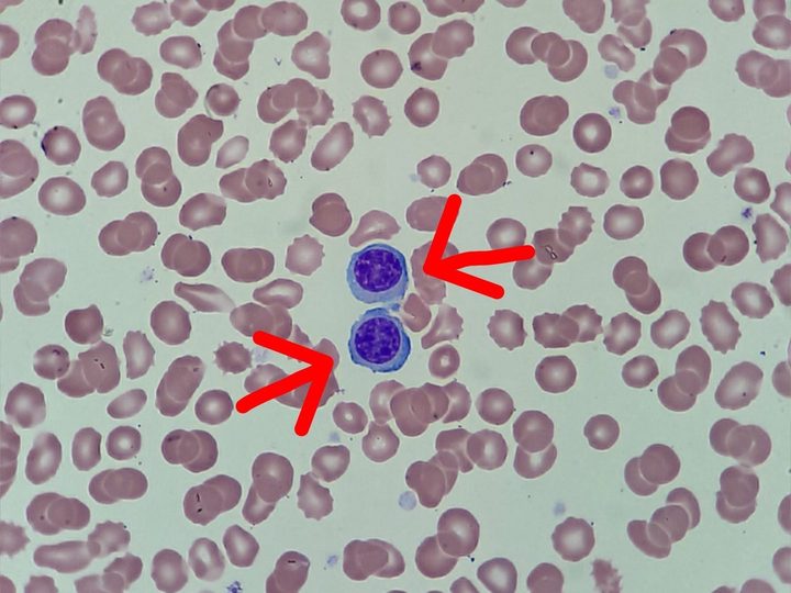Blood smear: a pair of circulating plasma cells in the microscopic field of view