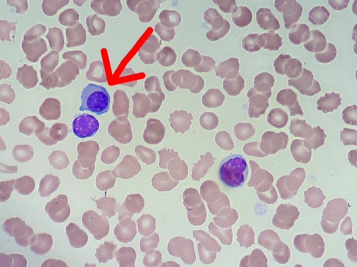 Blood smear: a plasma cell (arrow) compared to a small mature lymphocyte