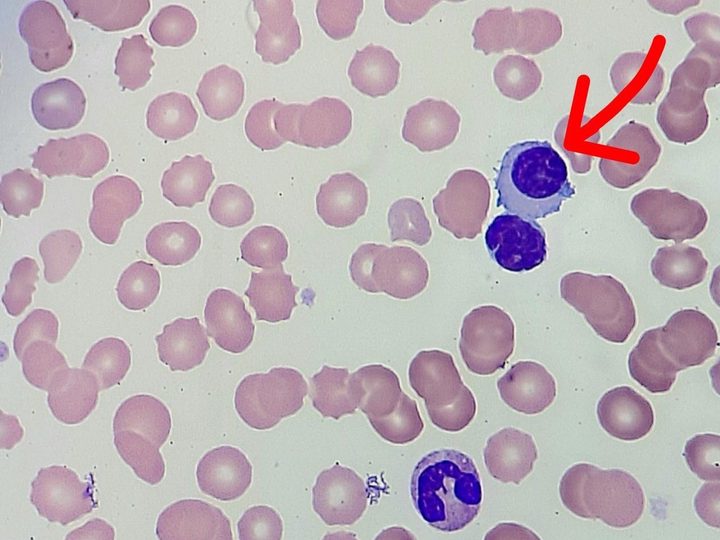 Blood smear: a plasma cell with a perinuclear halo and a lymphocyte